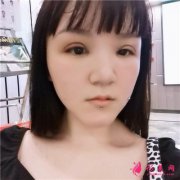 重慶切開雙眼皮術(shù)后恢復(fù)情況分享
