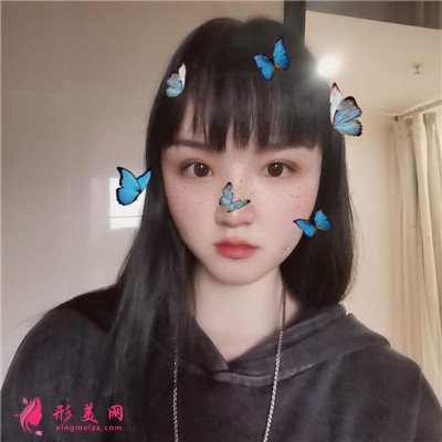 重慶切開雙眼皮術(shù)后恢復(fù)情況分享 術(shù)后 重慶切開雙眼皮術(shù)后恢復(fù)情況分享