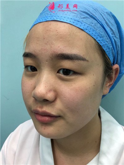 杭州小姐姐眼部綜合術(shù)后效果反饋