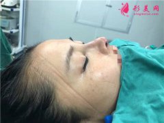 深圳鵬程醫(yī)院自體肋軟骨隆鼻術(shù)后恢復(fù)情況對比
