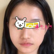 長沙美萊整形醫(yī)院面部吸脂案例分享，笑起來很自然