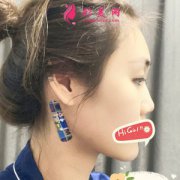 杭州同榮麗格醫(yī)療美容耳軟骨隆鼻效果圖分享 混血小翹鼻超美