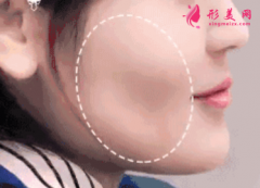 自體脂肪填充面部多少錢？
