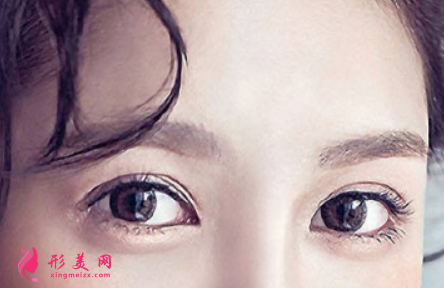 雙眼皮術(shù)后恢復(fù)得快嗎