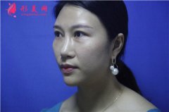 深圳鵬程醫(yī)院鼻綜合手術(shù)術(shù)后效果分享