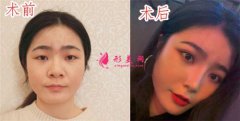 到南京美貝爾整形醫(yī)院做的切開雙眼皮，術(shù)后61天真人案例分享