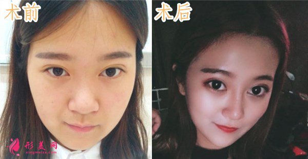 鄭州締萊美醫(yī)療美容醫(yī)院鼻部多項(xiàng)案例