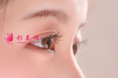 切開雙眼皮大約多少錢？