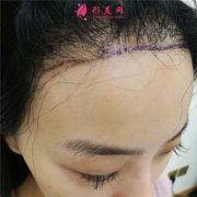 成都恒博植發(fā)小姐姐種植發(fā)際線術(shù)后效果分