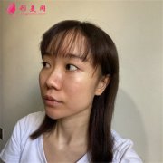 上海九院光子嫩膚術(shù)后恢復(fù)效果展示