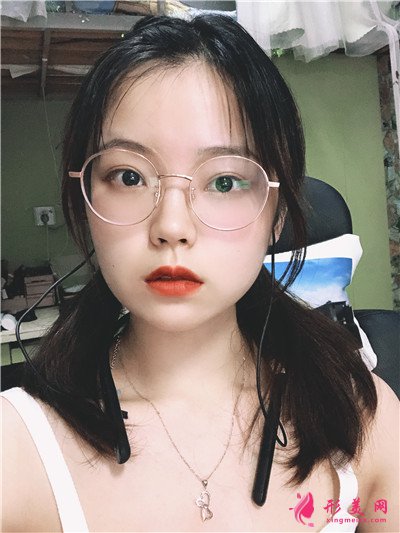 重慶切開雙眼皮術(shù)后恢復(fù)情況案例分享 術(shù)后 重慶切開雙眼皮術(shù)后恢復(fù)情況案例分享