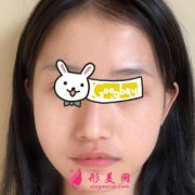 長沙美萊整形醫(yī)院面部吸脂案例 真的瘦了 笑起來也很自然