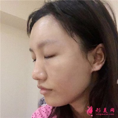 重慶自體脂肪面部填充案例反饋