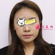 南京連天美整形醫(yī)院面部吸脂半個月效果圖 同事都夸我好美