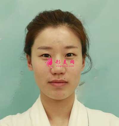 在上海愉悅美聯(lián)臣醫(yī)療美容醫(yī)院做全切雙眼皮手術(shù)前