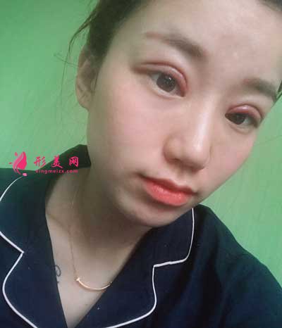 在上海愉悅美聯(lián)臣醫(yī)療美容醫(yī)院做全切雙眼皮手術(shù)后3天