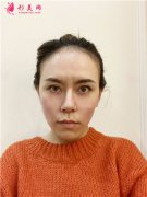 上海九院皮秒激光術(shù)后效果反饋，小姐姐的皮膚好好呀~