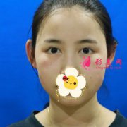 上海東方醫(yī)院整形科切開雙眼皮真人效果圖