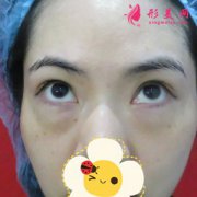 重慶軍美整形醫(yī)院內(nèi)切去眼袋效果圖