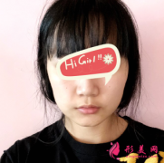 北京藝星整形醫(yī)院下頜角磨骨案例分享