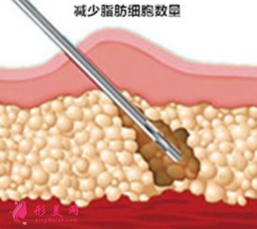 腰腹部吸脂需要多長(zhǎng)時(shí)間消腫
