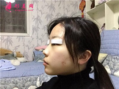 青島全切雙眼皮術(shù)后恢復(fù)情況反饋