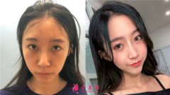 在寧波薇琳醫(yī)療美容做的眼部多項效果如何？真人案例對比圖分享！