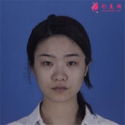 成都美容整形醫(yī)院耳軟骨隆鼻術(shù)后恢復(fù)效果展示