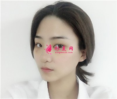 長(zhǎng)春耳軟骨隆鼻術(shù)后恢復(fù)效果展示