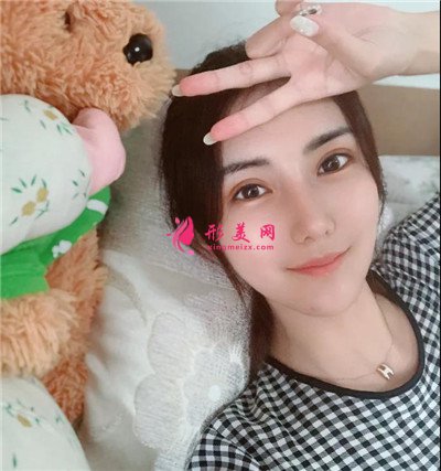 東莞切開雙眼皮術(shù)后恢復(fù)效果反饋 術(shù)后 東莞切開雙眼皮術(shù)后恢復(fù)效果反饋