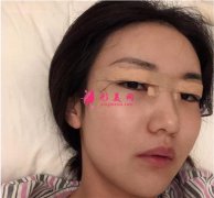 北京潤美玉之光醫(yī)療美容切開雙眼皮術后恢復效果反饋