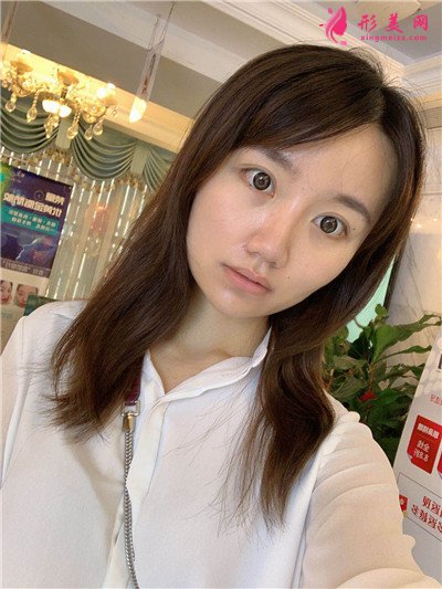 長沙吸脂瘦臉術(shù)后恢復(fù)效果對比圖分享