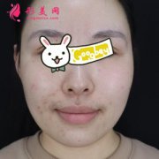 煙臺鵬愛整形醫(yī)院M唇案例 嘴唇性感又甜美