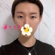 上海百達麗整形醫(yī)院切開雙眼皮案例分享