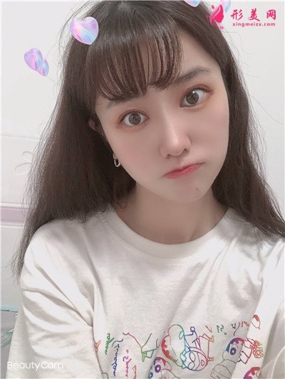 武漢眼部綜合案例反饋，這樣的雙眼皮我好喜歡~