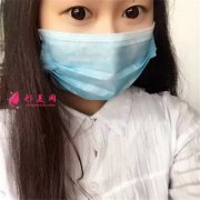 武漢藝星醫(yī)療美容眼部綜合案例反饋，這樣的雙眼皮我好喜歡~