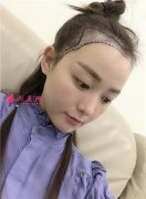 上海伊萊美種植發(fā)際線手術(shù)術(shù)后效果展示”