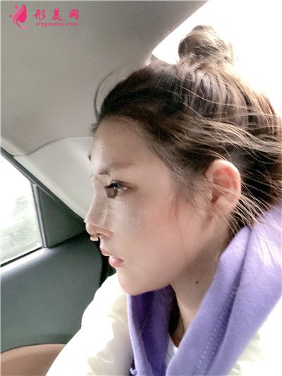 重慶小仙女鼻綜合術(shù)后效果對比