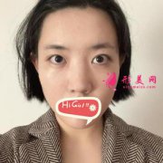 北京彤美整形醫(yī)院鼻綜合效果圖分享