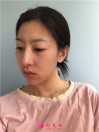 武漢小姐姐的鼻部綜合手術(shù)術(shù)后效果分享