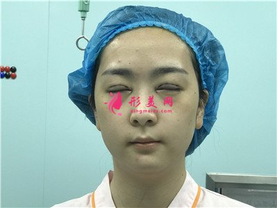 上海眼綜合術(shù)后恢復(fù)情況反饋