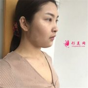 哈爾濱斯美諾醫(yī)療美容假體隆胸術(shù)后恢復(fù)情況對比