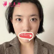 北京彤美整形醫(yī)院鼻綜合效果圖分享，打開新的大門