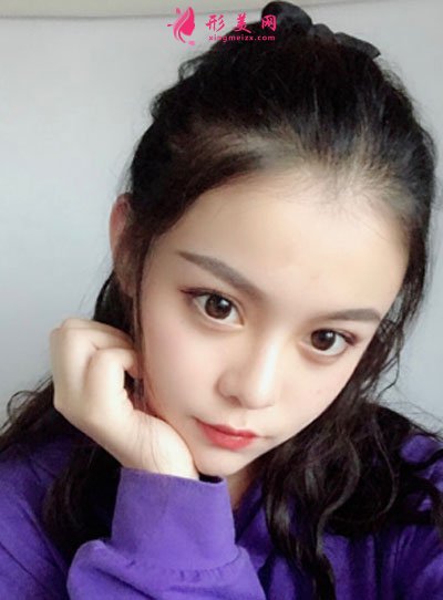 北京純脂自體做脂肪面部填充怎么樣？真實(shí)案例分