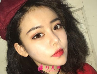 北京純脂自體做脂肪面部填充怎么樣？真實(shí)案例分