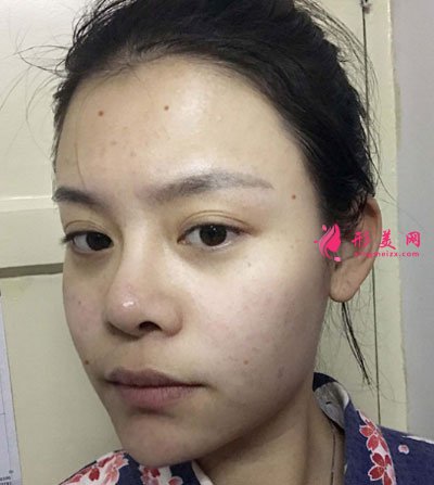 北京純脂自體做脂肪面部填充怎么樣？真實(shí)案例分