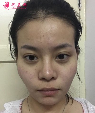 北京純脂自體做脂肪面部填充怎么樣？真實(shí)案例分