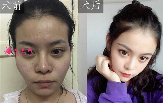 北京純脂自體做脂肪面部填充怎么樣？真實(shí)案例分