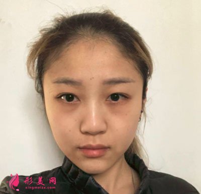昆明美伊萊醫(yī)療美容鼻部多項案例