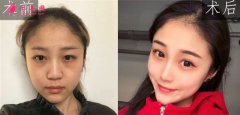 上海美伊萊醫(yī)療美容鼻部多項案例分享！術后60天擁有高鼻梁